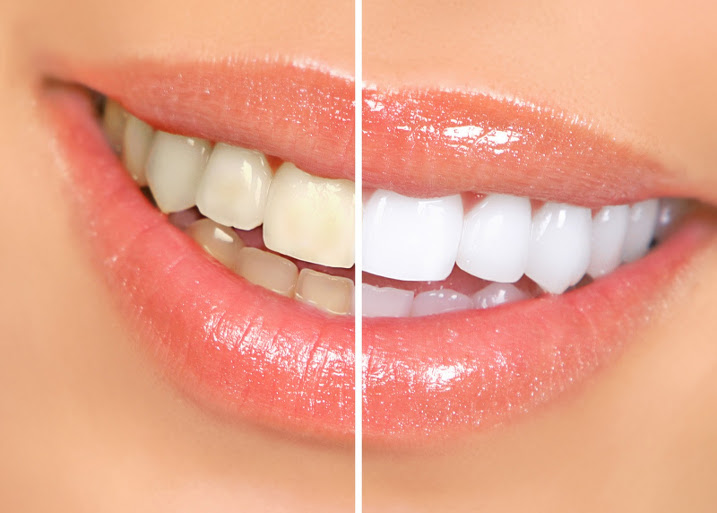 bleaching teeth treatment , close up, isolated on white, before and after